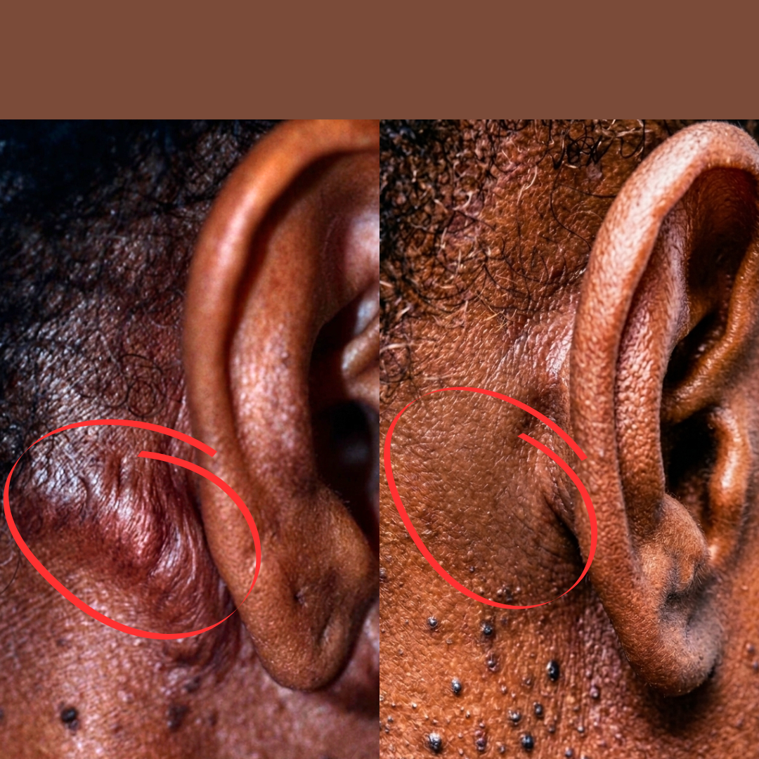 Keloid before after
