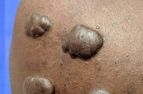 Keloid Scars